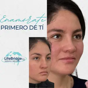 Rinoplastia, técnica estructural, rinoplastia sin dolor