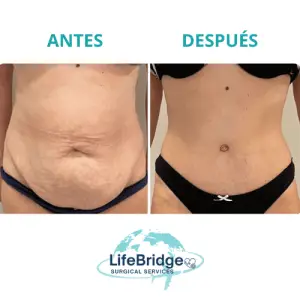 Abdominoplastia realizada por la Dra. Miguely Alcántara en el Manta Hospital Center, Manta Ecuador.