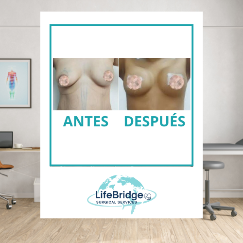 Mastopexia realizada por la Dra. Miguely Alcántara, cirujana plástica en el Manta Hospital Center, Manta Ecuador.