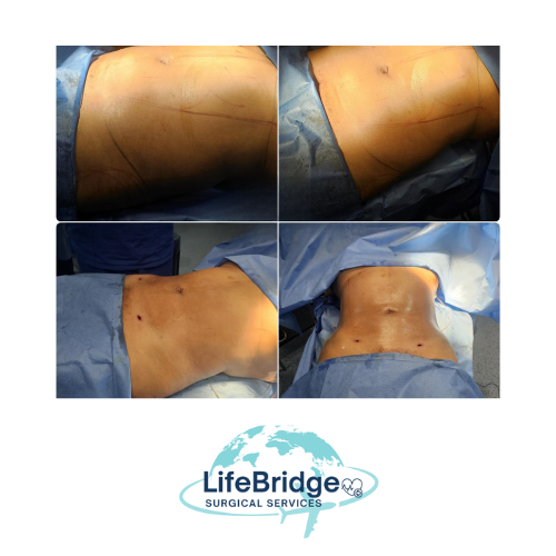 Lipo 360 realizada por la Dra. Miguely Alcántara en el Manta Hospital Center, Manta Ecuador.