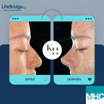 Antes y después de una rinoplastia ultrasónica realizada por la Dra. Katherine Hernández. Observa los resultados naturales y armónicos que transforman la apariencia del paciente mientras garantizan un proceso mínimamente invasivo y con una recuperación rápida.