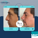Antes y después de una rinoplastia ultrasónica realizada por la Dra. Katherine Hernández. Observa los resultados naturales y armónicos que transforman la apariencia del paciente mientras garantizan un proceso mínimamente invasivo y con una recuperación rápida.