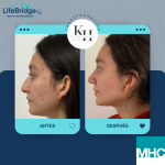 Antes y después de una rinoplastia ultrasónica realizada por la Dra. Katherine Hernández. Observa los resultados naturales y armónicos que transforman la apariencia del paciente mientras garantizan un proceso mínimamente invasivo y con una recuperación rápida.