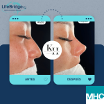 Antes y después de una rinoplastia ultrasónica realizada por la Dra. Katherine Hernández. Observa los resultados naturales y armónicos que transforman la apariencia del paciente mientras garantizan un proceso mínimamente invasivo y con una recuperación rápida.