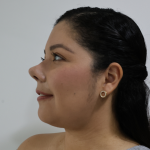 Antes y después de una rinoplastia ultrasónica realizada por la Dra. Katherine Hernández. Observa los resultados naturales y armónicos que transforman la apariencia del paciente mientras garantizan un proceso mínimamente invasivo y con una recuperación rápida.
