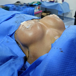 Aumento de senos realizado por la Dra. Miguely Alcántara, cirujana plástica en el Manta Hospital Center, Manta Ecuador.