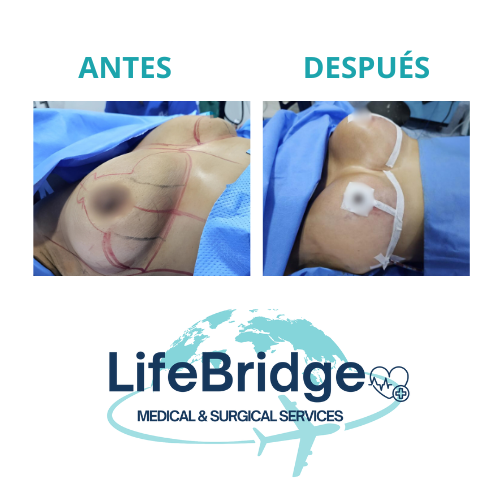 Aumento de senos realizado por la Dra. Miguely Alcántara, cirujana plástica en el Manta Hospital Center, Manta Ecuador.