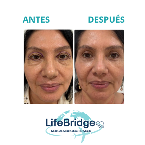 Blefaroplastia realizada por la Dra. Miguely Alcántara, cirujana plástica en el Manta Hospital Center, Manta Ecuador.