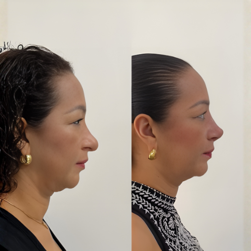 Corrección funcional y estética con Rinoplastia Ultrasónica
