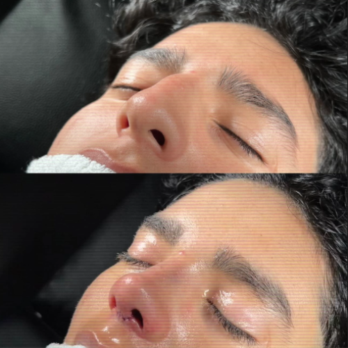 Resultado a los 15 días de una Rinoplastia Estructural Ultrasónica
