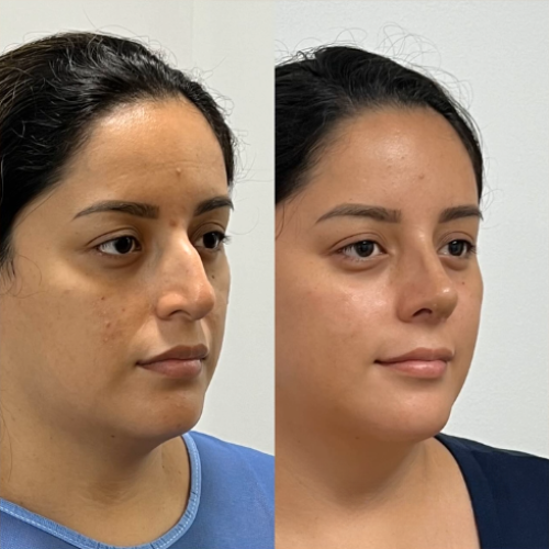 Resultado natural con refinamiento del dorso y mejor proyección nasal