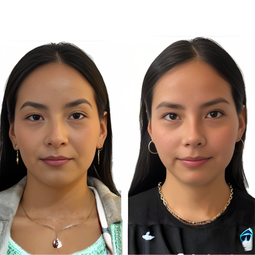Transformación con técnica ultrasónica: nariz más armoniosa y natural