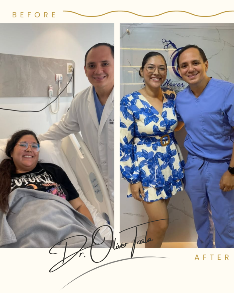Antes y después de bypass gástrico con resultados reales de pérdida de peso, realizado por el Dr. Oliver Toala.